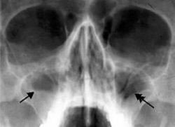 Odontogeninio Zandinio Sinusito Diagnostika Ir Gydymas Ligos Lt