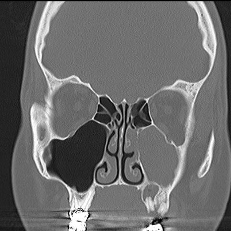 Odontogeninio Zandinio Sinusito Diagnostika Ir Gydymas Ligos Lt